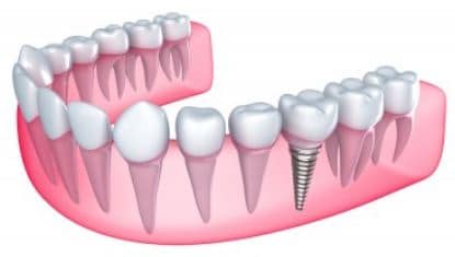Atlanta dental implant