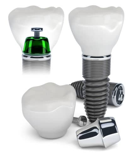 dental implants chandler