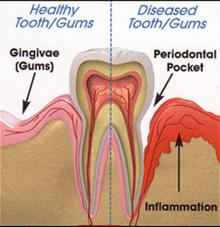 periodontal disease therapy chandler arizona dentist