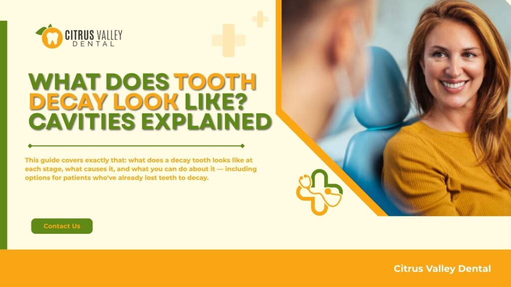 What Does Tooth Decay Look Like? Cavities Explained